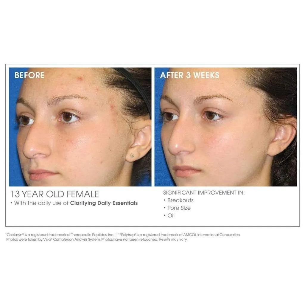 Acne Clarifying   Refining Treatment