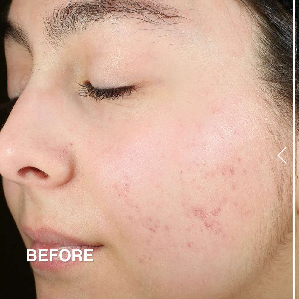 Acne Treatment Serum for Blemish Control