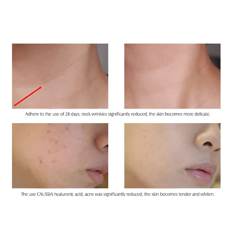 ARTISCARE HA Hyaluronic Acid Serum Moisturizing Essence Skin Face Care Cream Blackhead Acne Treatment Whitening Cream Ageless
