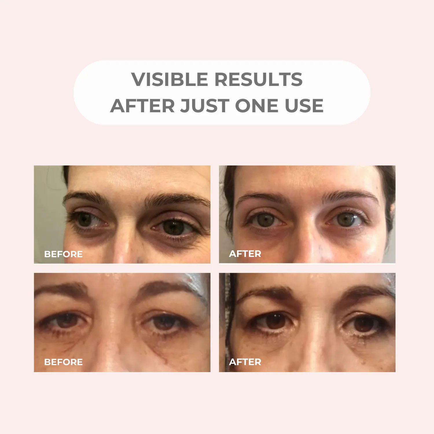 BEAUTICAL Microneedle Eye Patches - Anti-wrinkle, Anti-puffiness, Moisturizing - Eye Mask Hyaluronic Acid, Peptides - 1 pair