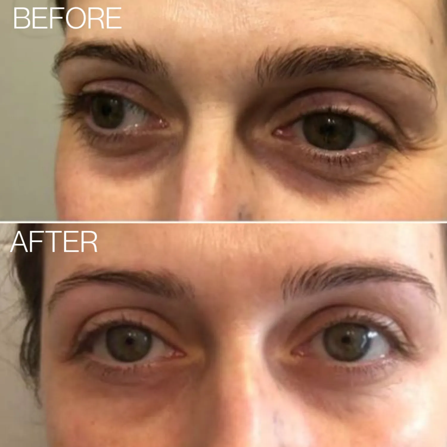 BEAUTICAL Microneedle Eye Patches - Anti-wrinkle, Anti-puffiness, Moisturizing - Eye Mask Hyaluronic Acid, Peptides - 1 pair
