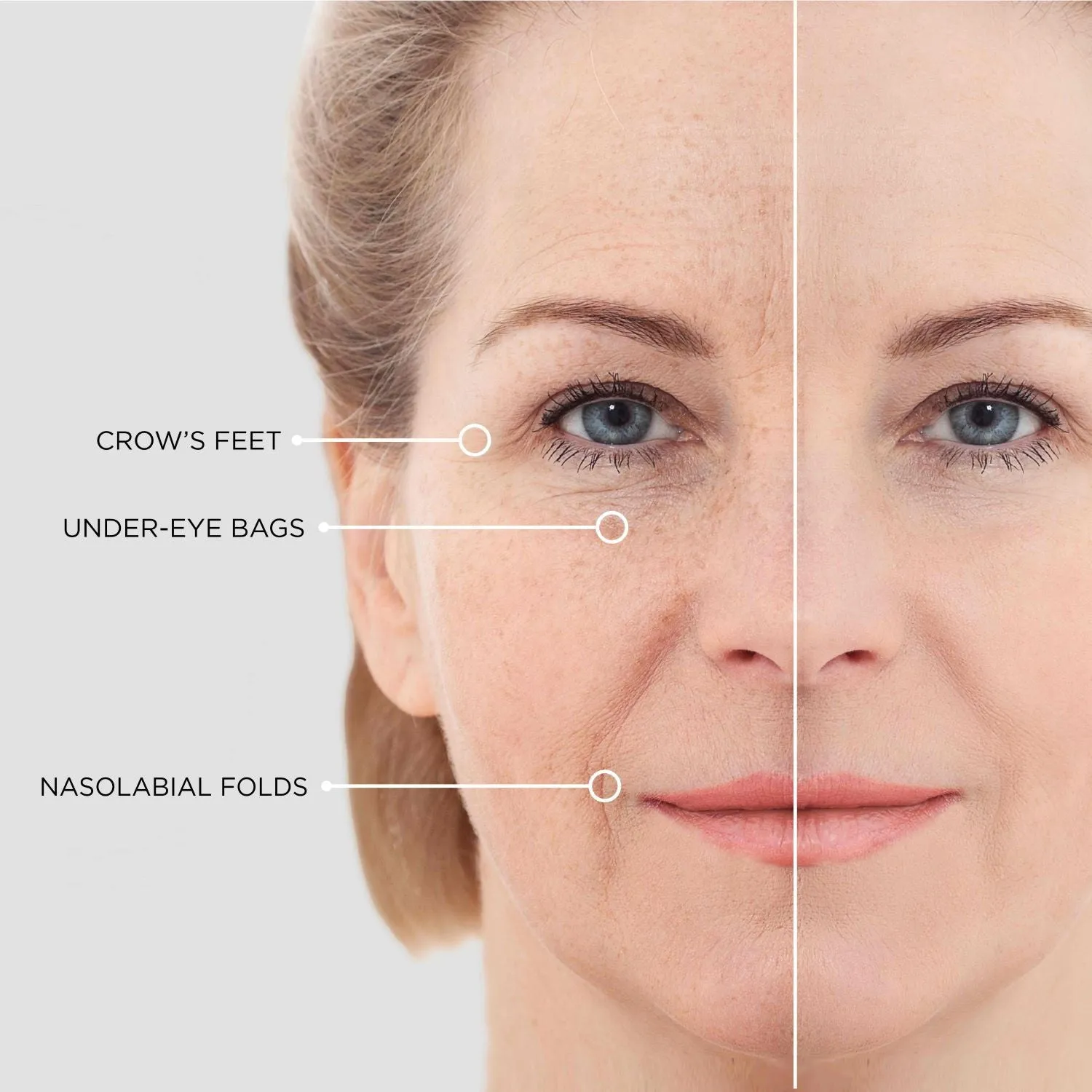 BEAUTICAL Microneedle Eye Patches - Anti-wrinkle, Anti-puffiness, Moisturizing - Eye Mask Hyaluronic Acid, Peptides - 1 pair