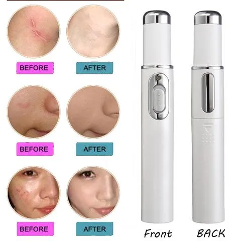 Blue Light Therapy Acne Laser Pen: Softens Scars and Reduces Wrinkles. Remove Treatments for Skin Care and Beauty Equipment.