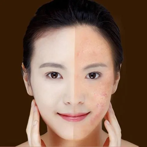 Blue Light Therapy Acne Laser Pen: Softens Scars and Reduces Wrinkles. Remove Treatments for Skin Care and Beauty Equipment.