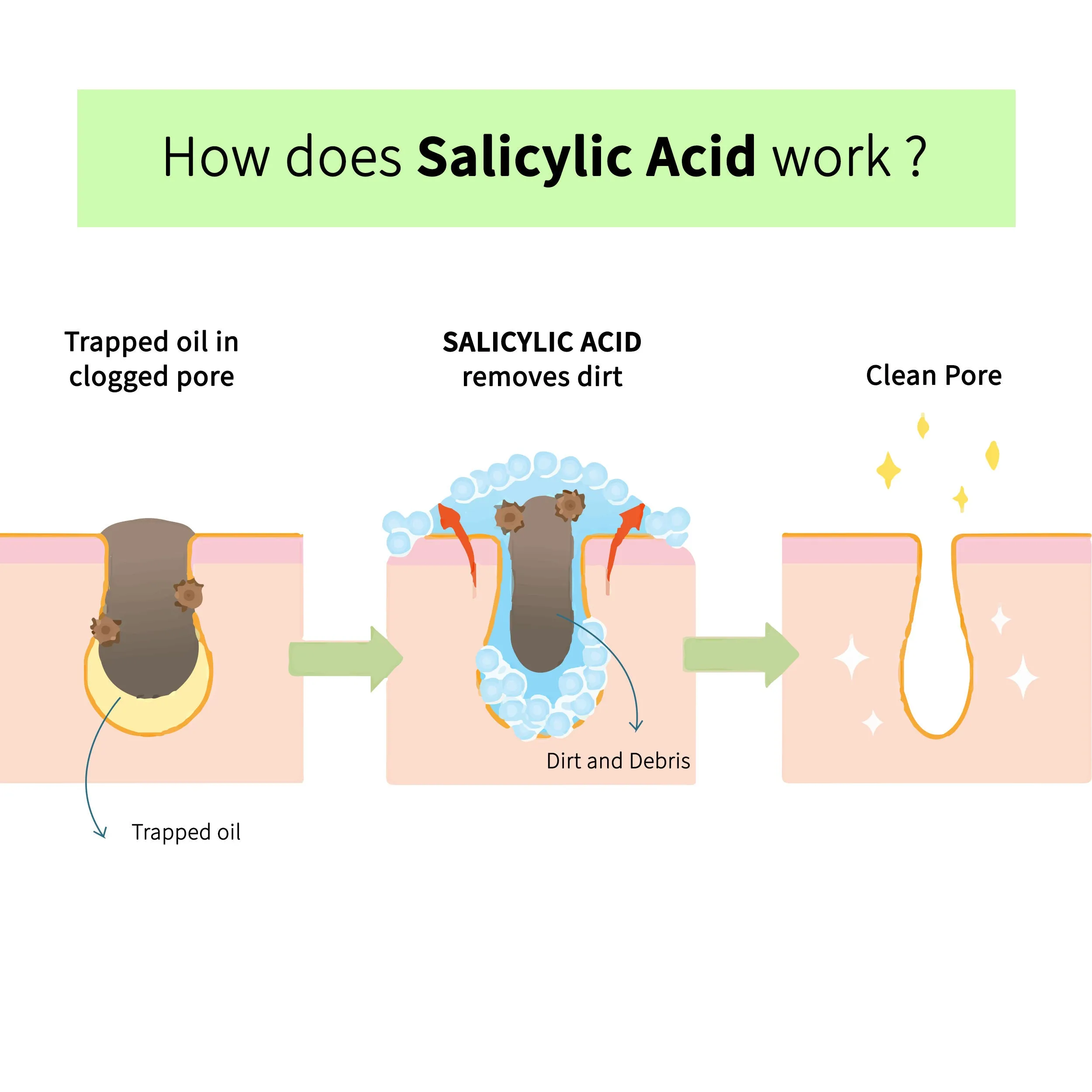 DermDoc Salicylic Acid Face Wash for Acne (120 ml)|For Oily & Acne Prone Skin|Reduces Acne & Blackheads, Regularizes Sebum Production, Evens Skin Texture|Paraben Free, Silicone Free, Sulfate Free, Cruelty Free