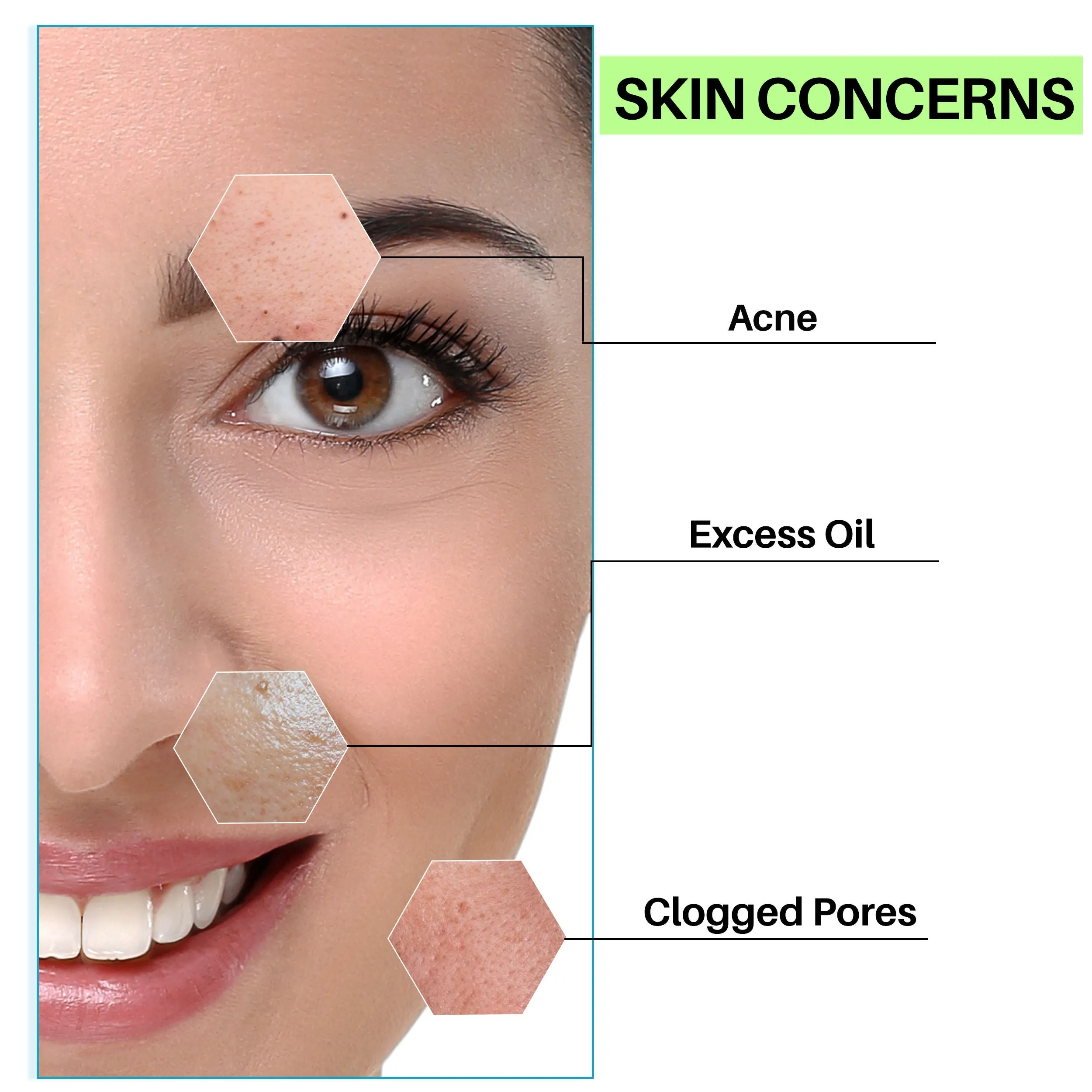 DermDoc Salicylic Acid Face Wash for Acne (120 ml)|For Oily & Acne Prone Skin|Reduces Acne & Blackheads, Regularizes Sebum Production, Evens Skin Texture|Paraben Free, Silicone Free, Sulfate Free, Cruelty Free