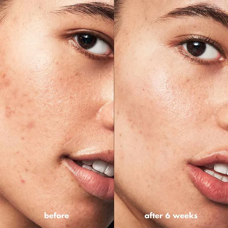 e.l.f. Blemish Breakthrough Blemish Fighting Spot Gel Discontinued