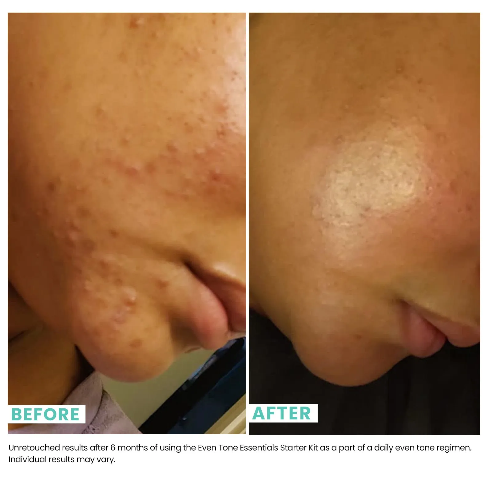 Even Tone   Dark Spot Kit