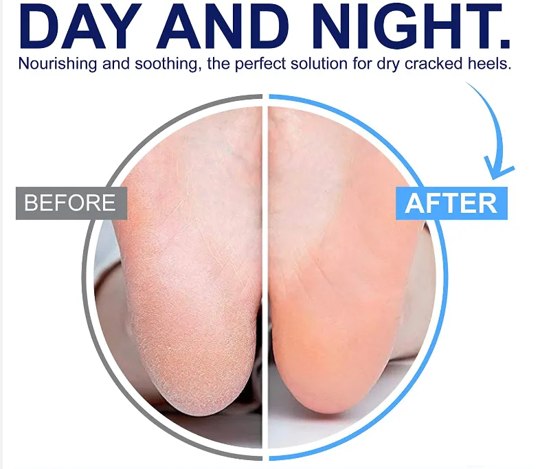 Foot Repair Cream - Cracked Heels - Callus Removal - Baby like Soft Feets