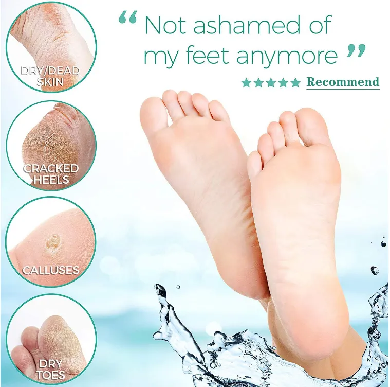 Foot Repair Cream - Cracked Heels - Callus Removal - Baby like Soft Feets