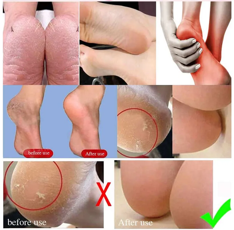 Foot Repair Cream - Cracked Heels - Callus Removal - Baby like Soft Feets