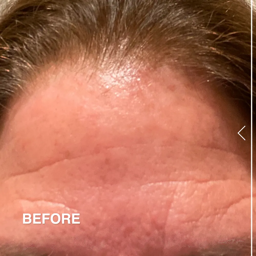 Stem Cell Lifting Eye Treatment