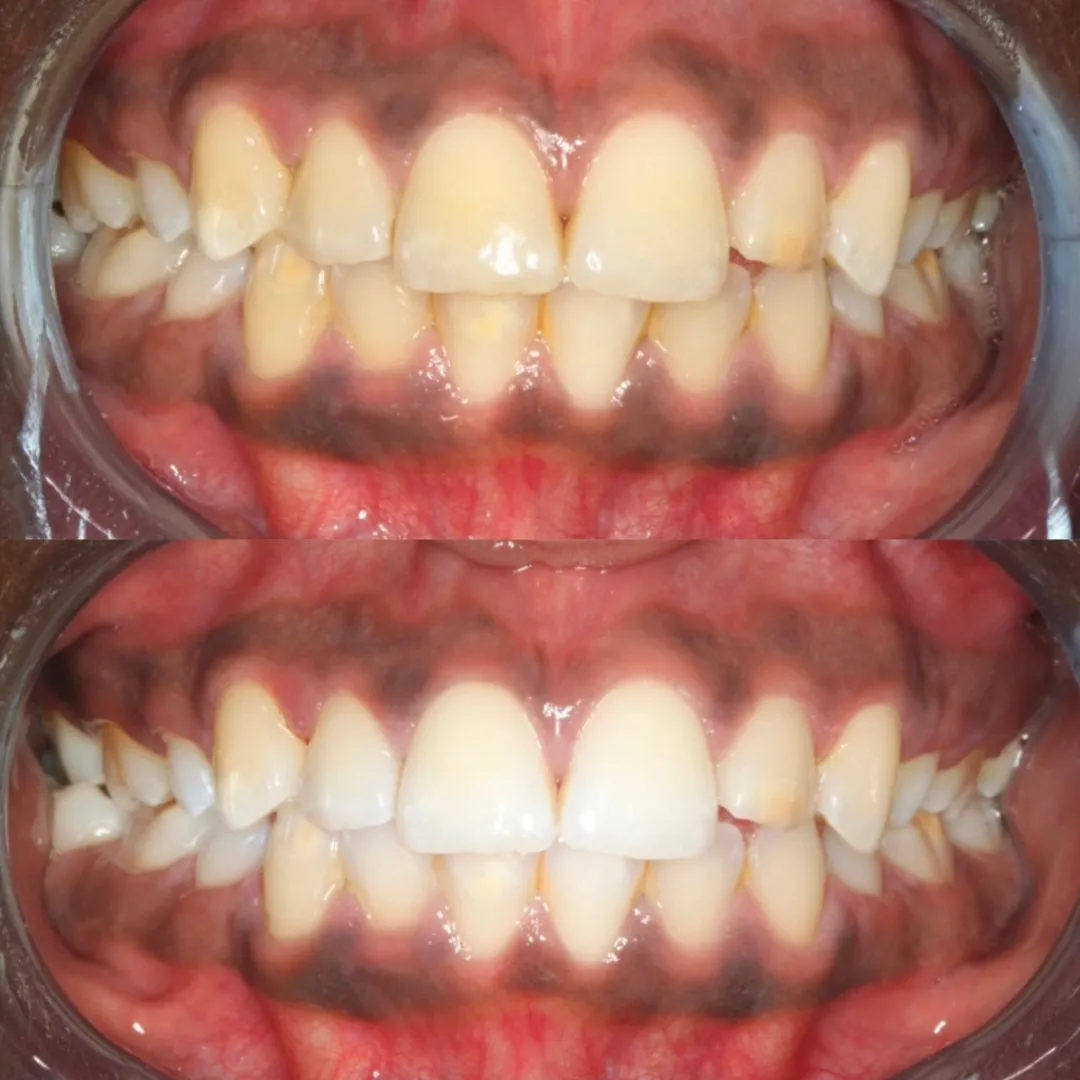Teeth Whitening Starter Bundle